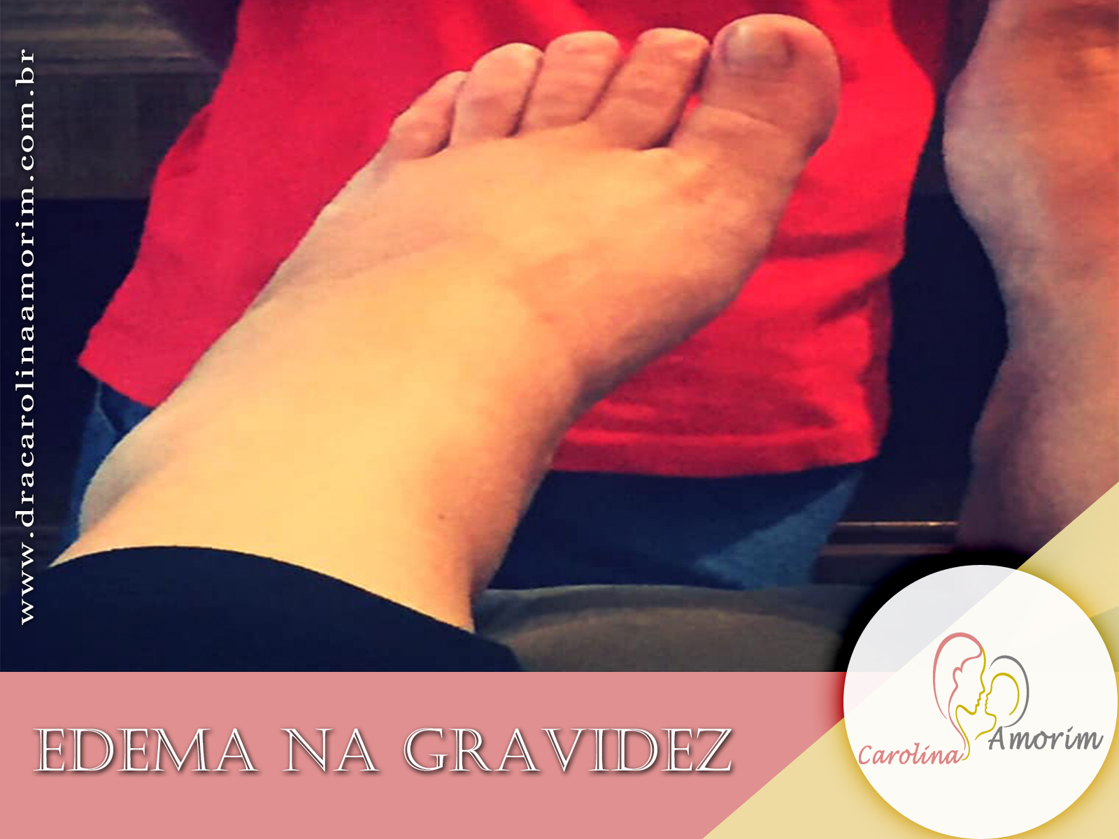 https://dracarolinaamorim.com.br/Edema na Gravidez